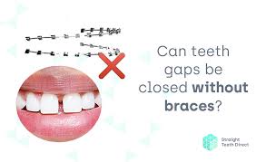 Cut the low back brace and the high back brace and set them on a flat surface. Teeth Gaps Can They Be Closed Without The Use Of Braces