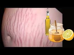 Goz Bolgesinde Olusan Kaz Ayagi Kirisikligi Nasil Gecer Kaz Ayagi Kirisikliklari Icin Egzersizl 2020 Evde Hazirlabilen Ilaclar Dogal Guzellik Ipuclari Dogal Saglik