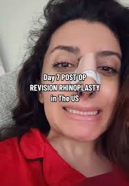 Día 7 Post Operativo de Rinoplastia en EE.UU.