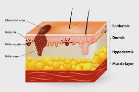 If breast cancer is diagnosed at an early enough stage, it's treatable. Skin Cancer Symptoms Types Causes Stages And Treatment