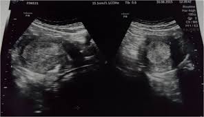 Saat hasil test pack menunjukkan garis dua, yang segera dilakukan calon ibu baru adalah mengunjungi dokter sesegera mungkin. Ria Buchari Hiperplasia Endometrium