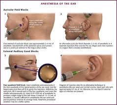 Image result for Ear Nerve Block