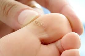 What Is Fish Eye On Foot Causes Of Fish Eye On Foot Treatments Of Fish Eye On Foot How To Cure Fish Eye On The Foot Warts Wart Treatment Get Rid Of Warts