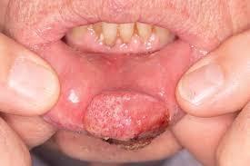 Image result for dental cancer