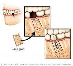 Thanks to participating practitioners, and a commitment on your part, you can qualify for a dental grant that will reduce the cost of your dental work by up to 30%, depending on your procedure. Dental Implant Surgery Mayo Clinic