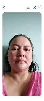 First pic B4 face lift second pic after face lift .I regret it not take  advice of surgeon to liposuction of my face prior to lift.now I m still  fell insecure in