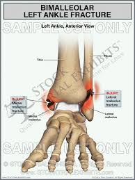 This Trial Exhibit Depicts A Bimalleolar Left Ankle Fracture Showing Fractures Of Both The Medial Malleolus And Lateral Ankle Fracture Ankle Anatomy Fracture