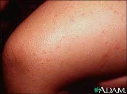 Check spelling or type a new query. Got Hbv What Is Your Skin Trying To Tell You Hepatitis B Foundation