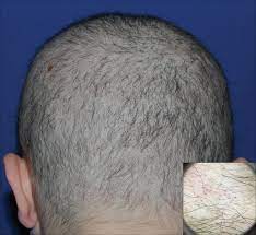 In most people, new hair eventually grows back in the affected areas, although this process can take months. Diffuse Nonscarring Alopecia Mdedge Dermatology