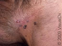 Image result for genital warts
