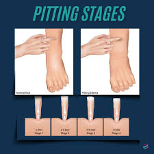 Image result for Edema Exam