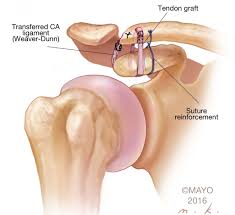 How to fix a separated shoulder. My Shoulder Is Separated Do I Need Surgery Injuries To The Acromioclavicular Ac Joint Shoulder Elbow