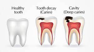 Picture of human body cavities — dorsal body cavity to the left and ventral body cavity to the right. Are Dental Caries And Cavities The Same Thing Choice Dental