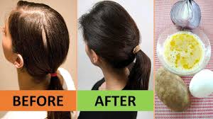 I Got Fuller Hair After Curing My Baldness Naturally Using Only 4 Ingredients I Ap Hair Remedies For Growth Hair Growth Home Remedies Hair Thickening Remedies