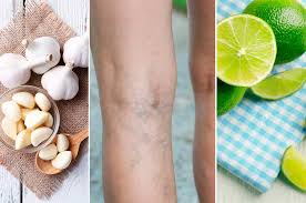 Pomada Para Prevenir Las Varices Portada Cocina Vital