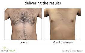 Laser hair removal is one of the best ways of hair removal as it gives permanent solutions in most cases. Laser Hair Removal Green Bay Ambiance Md Medical Spa