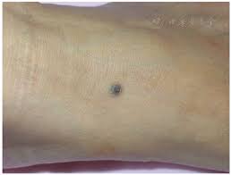 Image result for Blue Nevus