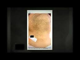 Many clinics offer laser hair removal, but there are several very good reasons why you should choose vivo clinic. Male Laser Hair Removal Dublin S Leading Male Laser Hair Specialist