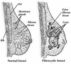 In fact, a 2017 study published in the journal cancer epidemiology found that 1 in 6 women diagnosed with breast cancer experience a spectrum of symptoms other than breast lump. Breast Lumps