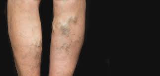 Maryland vein professionals, llc is a provider established in columbia, maryland specializing in thoracic surgery (cardiothoracic vascular surgery). Varicose Veins In Laurel Can Weight Loss Affect Them The Vein Center