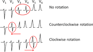 What is the geometry rotation definition and what is the definition of rotation in math? Counterclockwise And Clockwise Rotation Of Qrs Transitional Zone Prospective Correlates Of Change And Time Varying Associations With Cardiovascular Outcomes Journal Of The American Heart Association