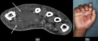 Image result for phlegmon of hand)