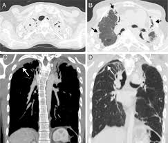 La droga de elección es la anfotericina b i.v. Neoplasias Hematologicas Interpretacion De Los Hallazgos Pulmonares En La Tomografia Computarizada Toracica Sciencedirect