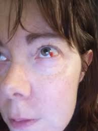 Does anyone have allodynia from having diabetes? It's when your skin feels  like it's bruised but there is no bruise there?