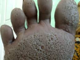 Image result for brown patches on the feet