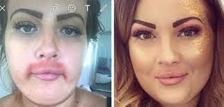 Some skin types experience adverse reactions even when following instructions. Woman Left With Embarrassing Burns After Moustache Removal Cream Disaster Heart