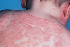 Image result for sweat rash on back baby