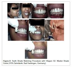 Relationship Of Facial Skin Complexion With Gingiva And