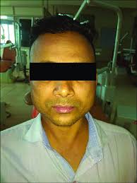 Extraoral photograph showing mild bilateral parotid gland swelling with... 