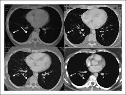The problem is that often a ct scan will result in a false positive (in which a biopsy would reveal another condition) or false negative. Fig 4 Long Term Follow Up Of Patients With Malignant Pleural Mesothelioma Receiving High Dose Adenovirus Herpes Simplex Thymidine Kinase Ganciclovir Suicide Gene Therapy Clinical Cancer Research