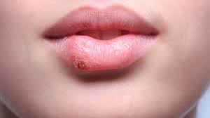Gejala Penyakit Herpes Zoster Penyebab Dan Cara Mengobatinya Health Liputan6 Com