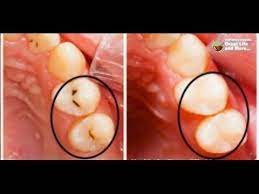 Here Is How To Fill Cavities Without Going To The Dentist Cavities Gum Disease Treatment Heal Cavities