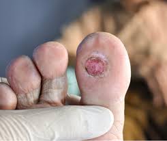 Image result for diabetic toes