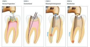 Check spelling or type a new query. The Warning Signs That You Need A Root Canal Treatment Lotus Dental Group Lotus Dental Group Lotus Dental Group