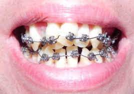 There is a simple way to identify whether your teeth are cooked or not. Risks Of Do It Yourself Braces At Homedr Jacquie