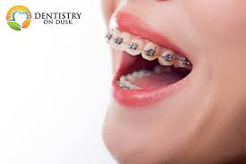 How can i make my teeth straight without braces? A Guide To Different Types Of Dental Retainers Dentistryondusk