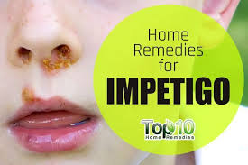 Impetigo Home Remedies Prevention And When To See A Doctor Top 10 Home Remedies Impetigo Top 10 Home Remedies Remedies