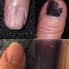 A new or changing vertical black or brown streak in a fingernail or toenail may be a sign of melanoma, the most serious type of skin cancer. What Does Nail Melanoma Look Like Skin Cancer Can Hide As Line On Nail