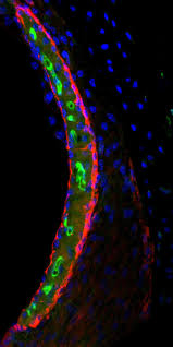 Cisplatin may cause hearing changes, including hearing loss. Potential Cause Of Cisplatin Linked Hearing Loss Identified National Cancer Institute