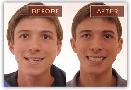 We did not find results for: Before After Braces