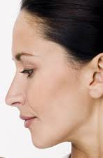 Chin Surgery Carmel IN