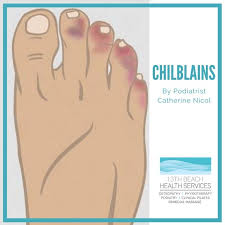 Image result for Chilblains