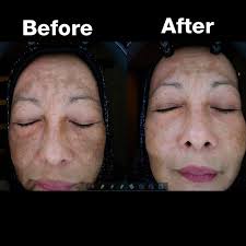 Klinik Hana Combination Treatment For Melasma Laser Facebook