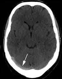 A statement for healthcare professionals from the american heart association/american stroke association. Radiologic Clues To Cerebral Venous Thrombosis Radiographics