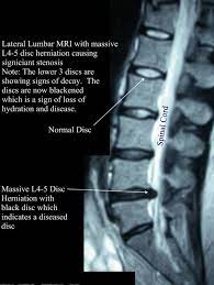 Tahukah anda, terdapat beberapa lagi rawatan slip disc tanpa pembedahan, seperti: 5 Punca Kenapa Makin Ramai Anak Muda Kena Slipped Disc 1 Selalu Memandu Kenderaan Remaja