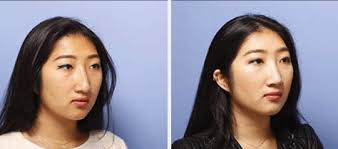 Asians do not have the smallest noses, there's are actually very wide. Ethnic Rhinoplasty Nyc Asian African American Nose Jobs Manhattan